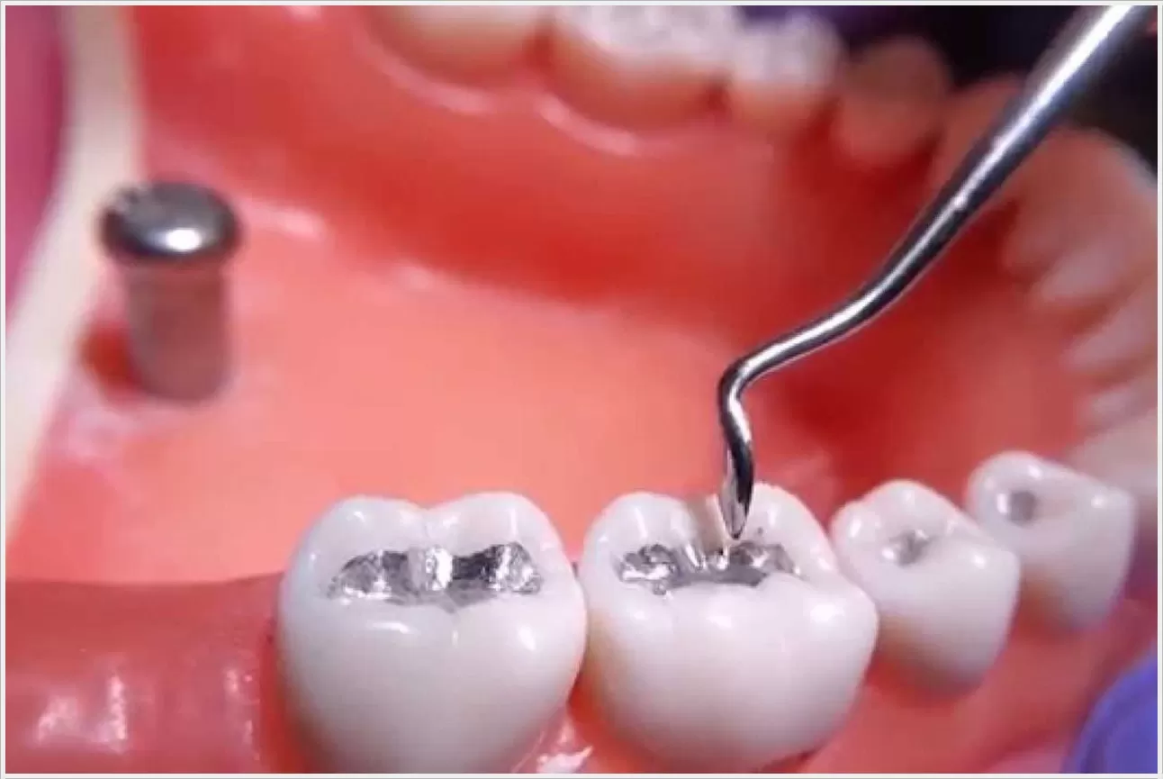 Dental Filling