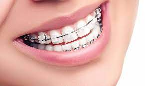 Traitement Orthodontique